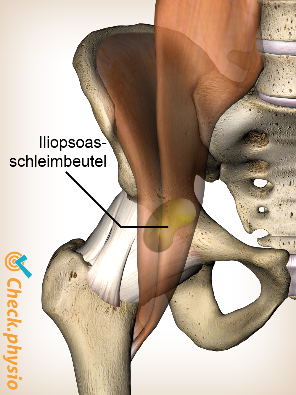 Hüfte Iliopsoas Bursa Bursitis