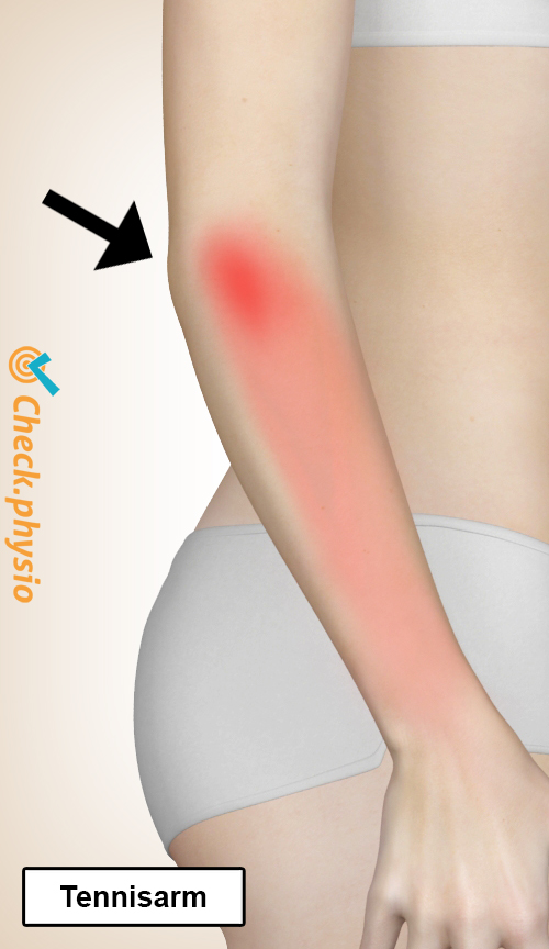 arm Tennisarm Lokation