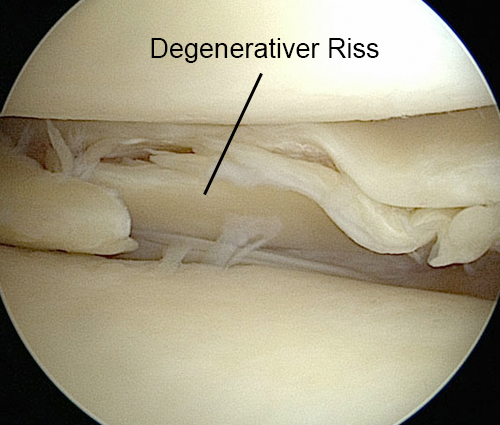 Knie Meniskusdegeneration degenerativ