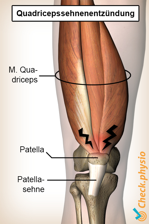 Knie Quadrizepstendinitis Anatomie