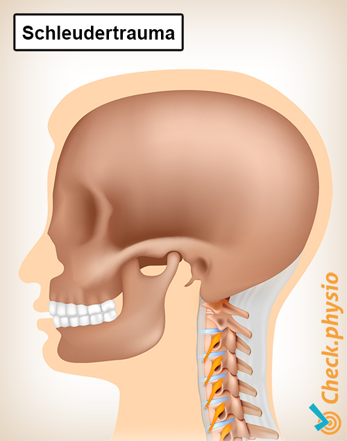 Nacken Schleudertrauma Schmerz