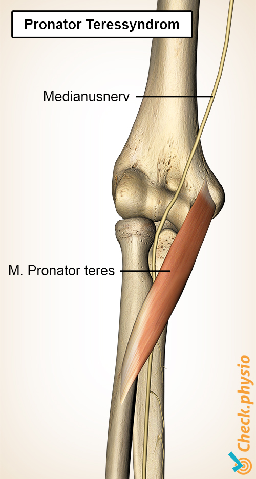 Unterarm Pronator teres Muskel Medianus Nerv Syndrom