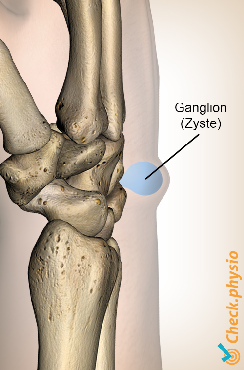 Handgelenksganglion Zyste Anatomie