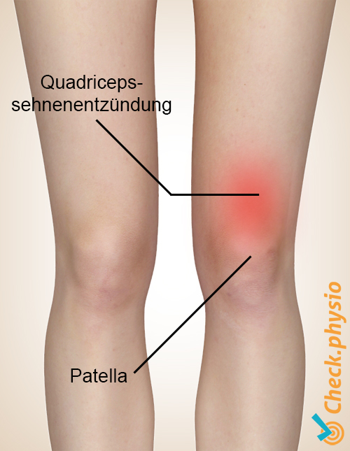 Quadrizepstendinitis