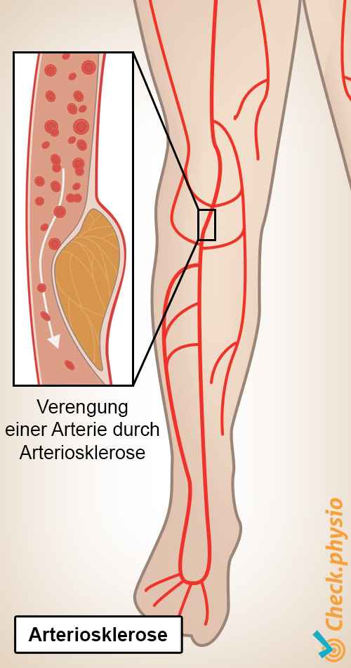 Bein Schaufensterkrankheit Claudicatio Intermittens Plaquebildung