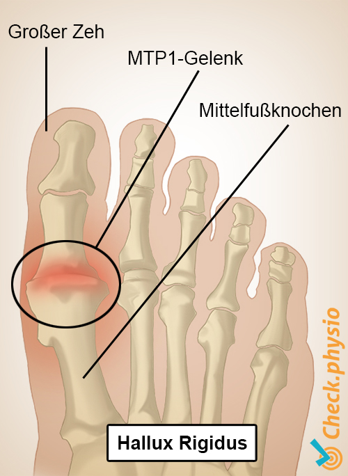Fuß Hallux Rigidus Großzeh MTP 1-Gelenk