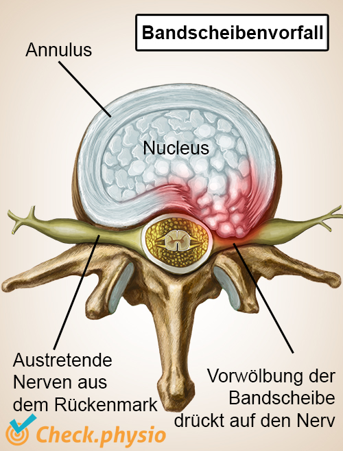 afbeelding_alt_wervelkolom-wervel-tussenwervelschijf-hernia-zenuwen