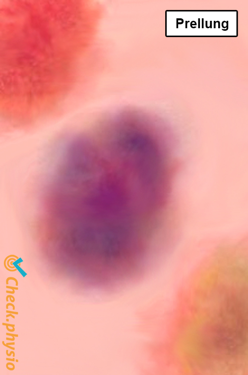 Kontusion Prellung Farbe Bluterguss rot gelb