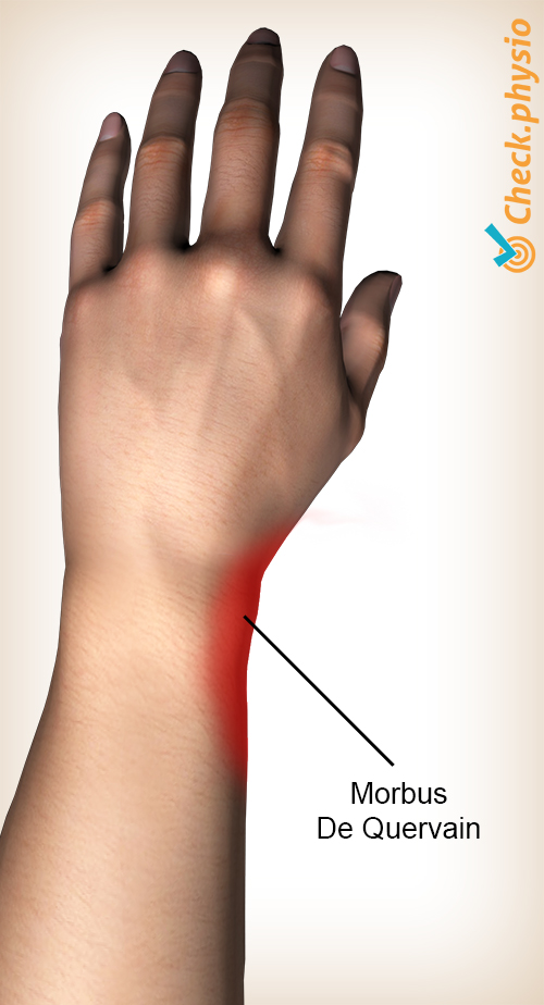 Morbus De Quervain Ursache Symptome Behandlung Morbus De Quervain Ursache Symptome Behandlung