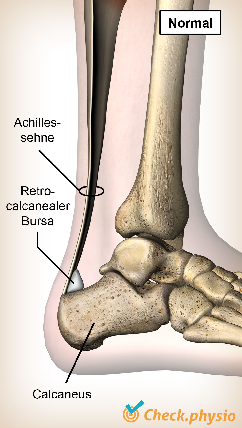 Sprunggelenk Achillessehne Bursa Retrocalcanea Fersenbein Calcaneus