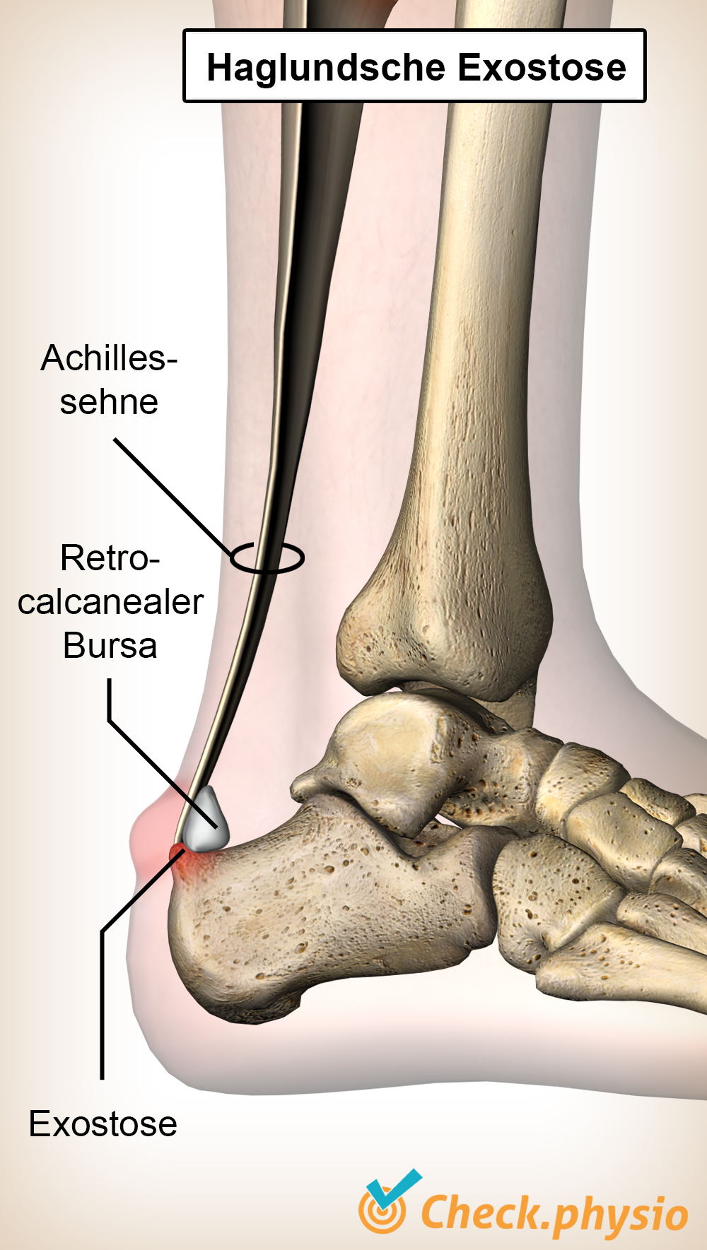 Sprunggelenk Haglund-Exostose Deformität Achillessehne Bursa Retrocalcanea Fersenbein Calcaneus