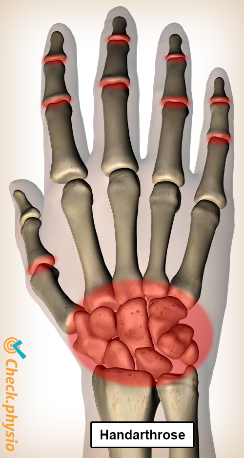 Handarthrose Schmerzlokalization