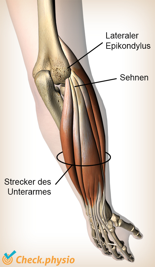 Armextensoren