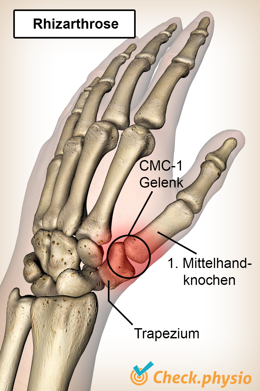 Hand Daumen Daumengrundgelenk Arthrose Os Trapezium Mittelhandknochen Metacarpale- CMC 1-Gelenk