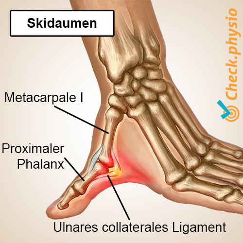 Hand Skidaumen