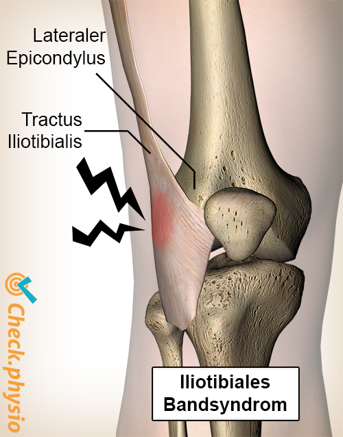 Knie Iliotibialbandsyndrom laterale Epikondylus