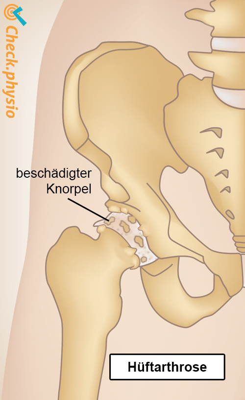 Hüftarthrose