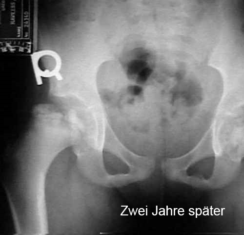 Hüfte Legg-Calvé-Perthes Altes 8