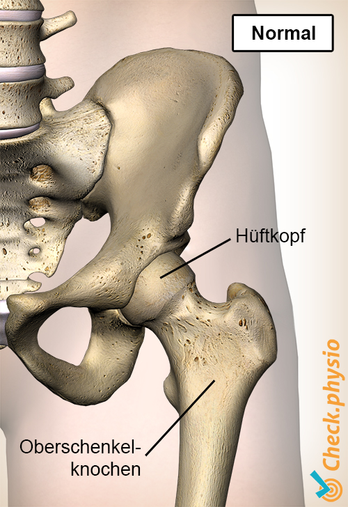 Hüfte Epiphysiolysis Capitis Femoris normal