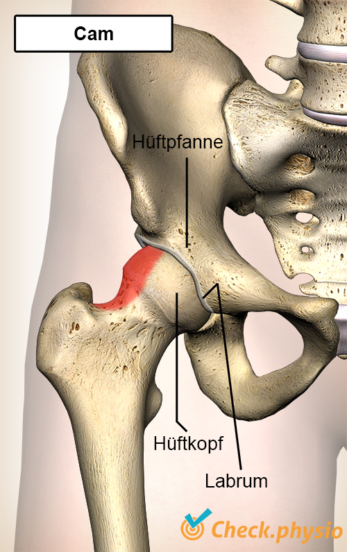 Hüfte Femoroacetabuläres Impingement FAI Cam